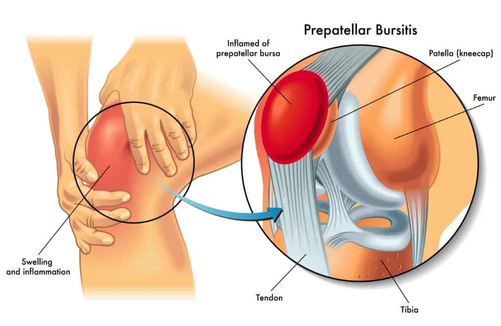 Bursite pré-rotulienne : inflammation de la bourse séreuse