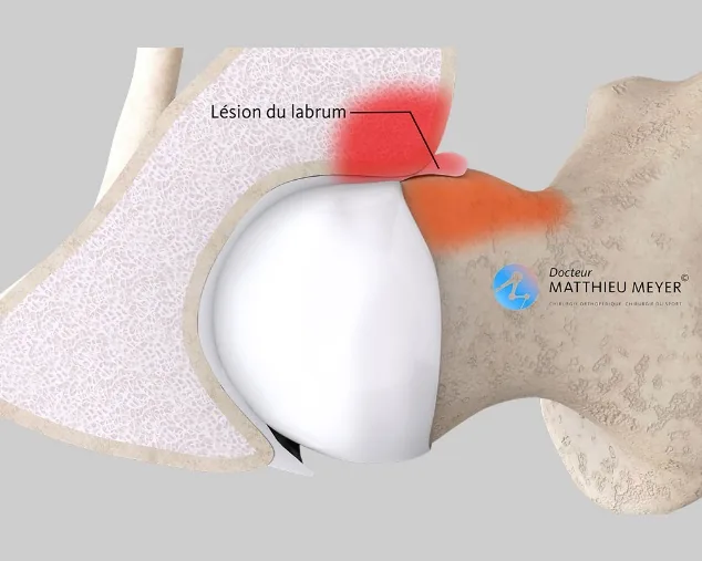 Conflit antérieur avec lésion du labrum