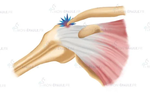 Conflit entre l’acromion et les tendons de la coiffe