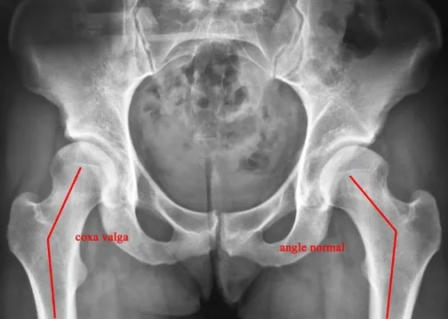 Coxa valga : angle cervico-diaphysaire augmenté