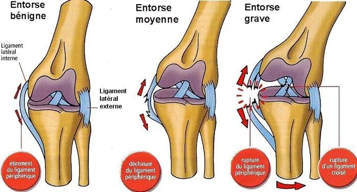 Entorse du genou : bénigne, moyenne et grave