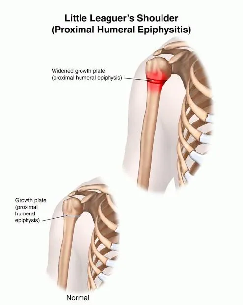 Épaule du jeune lanceur : atteinte du cartilage de croissance