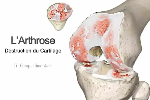 Arthrose du genou : destruction du cartilage