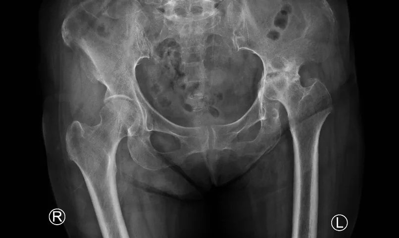 Ostéonécrose de la tête fémorale à la radiographie