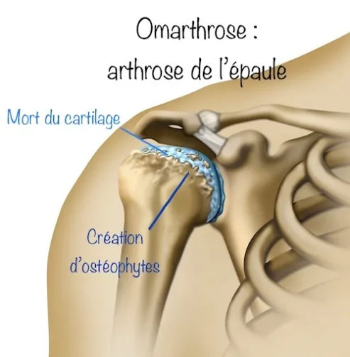 Omarthrose : arthrose de l'épaule
