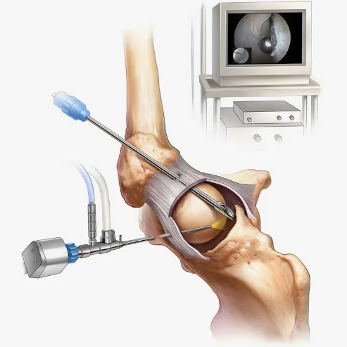 Arthroscopie pour lésion du labrum