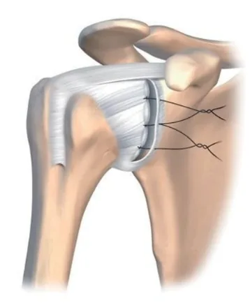Réparation capsulo-labrale de type Bankart