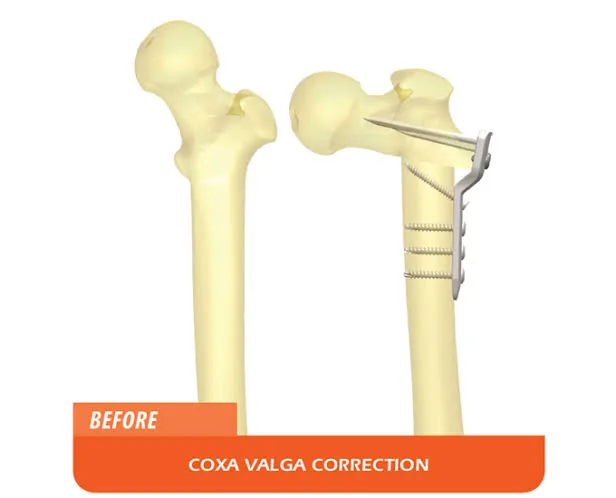 Correction de la coxa valga : avant / après