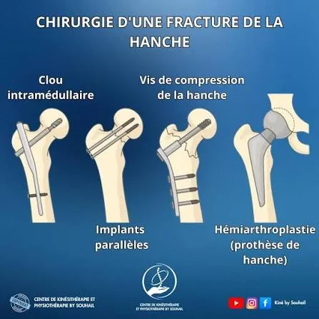 Clou, vis, implants ou prothèse selon la fracture