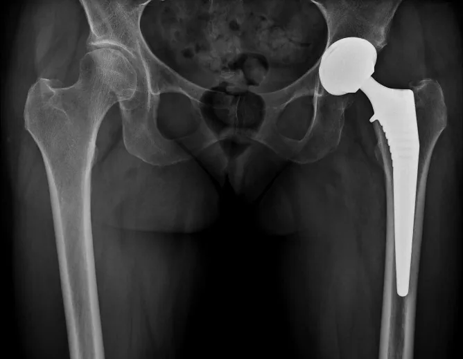 Prothèse totale de hanche à la radiographie