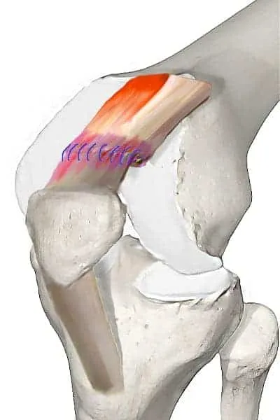 Suture du tendon quadricipital