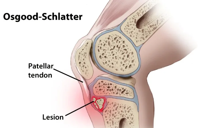 Maladie d'Osgood-Schlatter : lésion à l'insertion du tendon rotulien