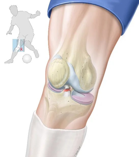 Rupture du ligament croisé antérieur