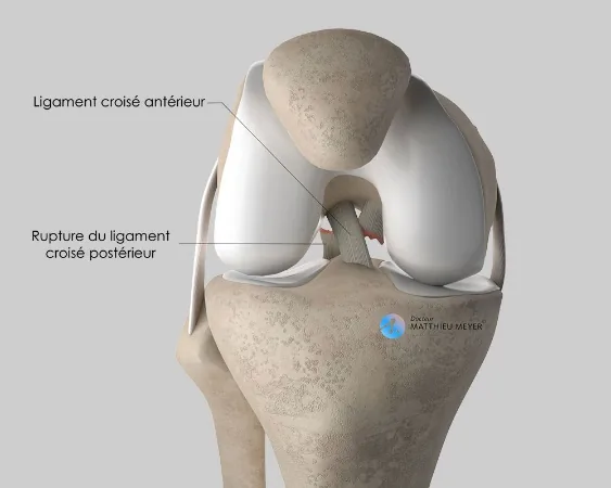 Rupture du ligament croisé postérieur (vue antérieure)