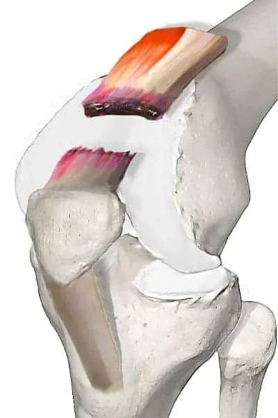 Rupture du tendon quadricipital