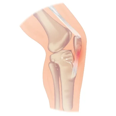Tendinopathie du tendon rotulien